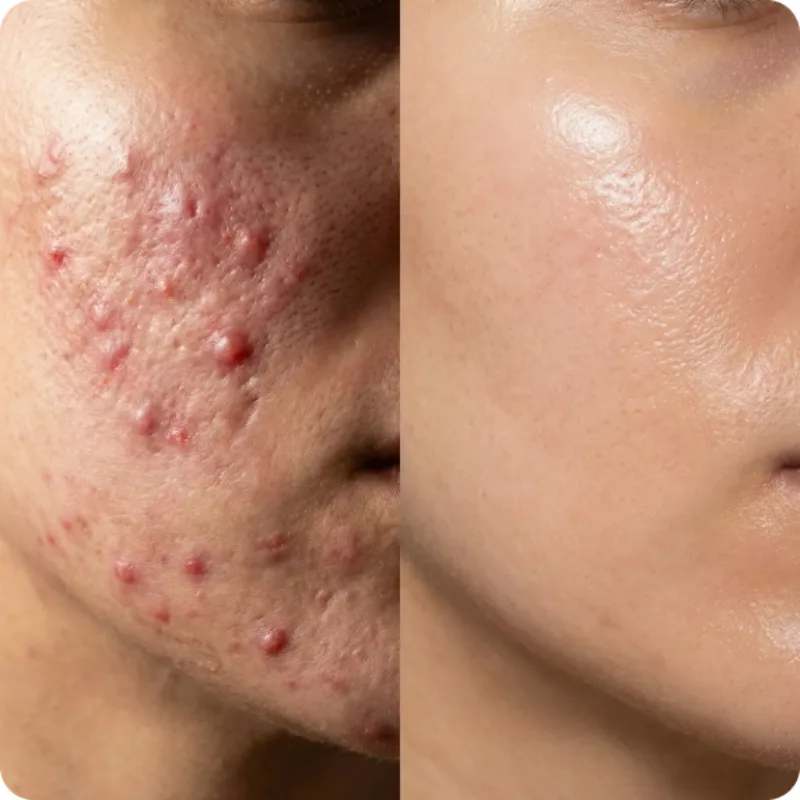 Layered Korean Ingredients Prevent Scars