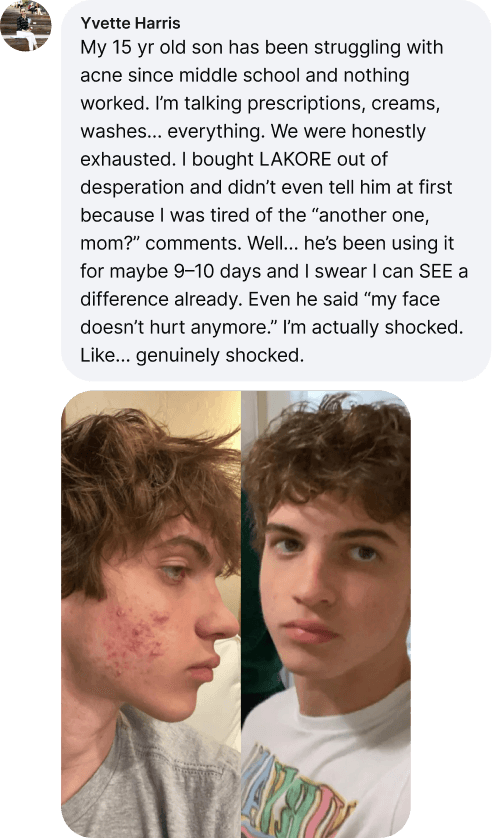 Yvette Harris Review - My 15 year old son acne improvement in 9-10 days with LAKORE
