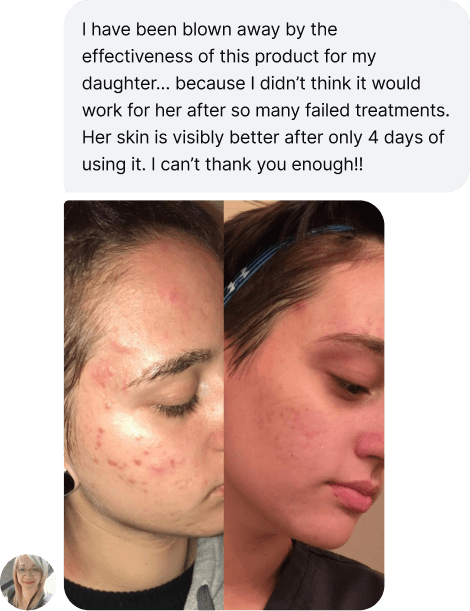 Teen skin healing before after